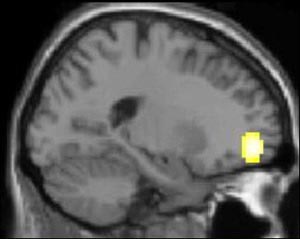 Biological Basis for Depression Orbitol frontal cortex different in depressed